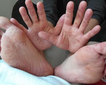 La enfermedad de manos y pies ataca a niños, sobre todo a menores de 5 años.